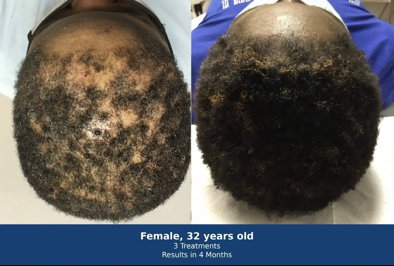 Hair regeneration before and after