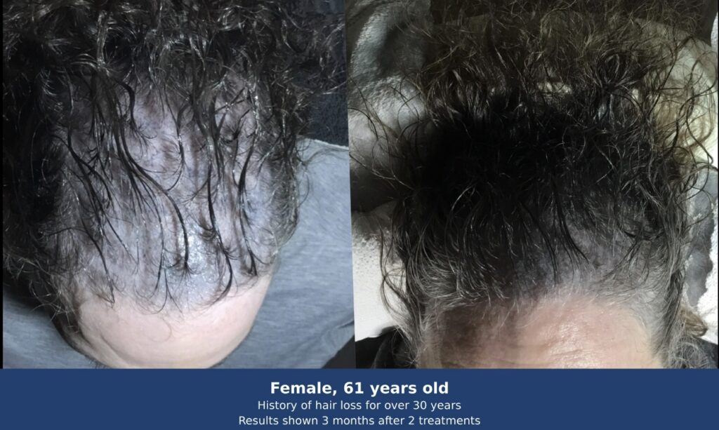 Female, 61 — hair regeneration after 2 Microfocused Ultrasound treatments at PROGEN