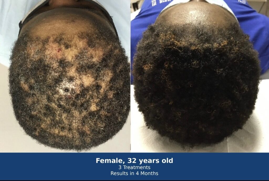 Female, 32 — hair regeneration after 3 Microfocused Ultrasound treatments at PROGEN