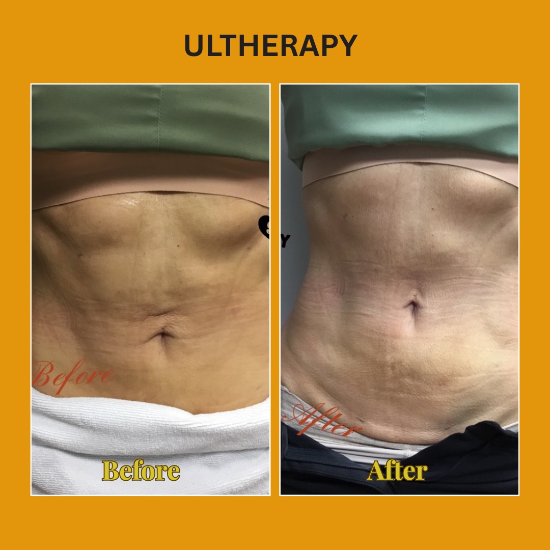 Abdomen before and after Ultherapy