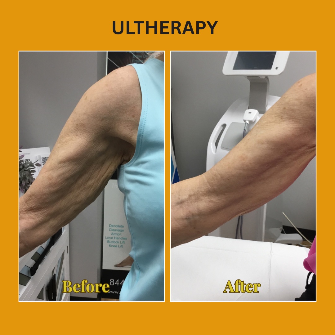Arm before and after Ultherapy