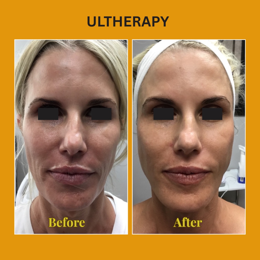 Face before and after Ultherapy