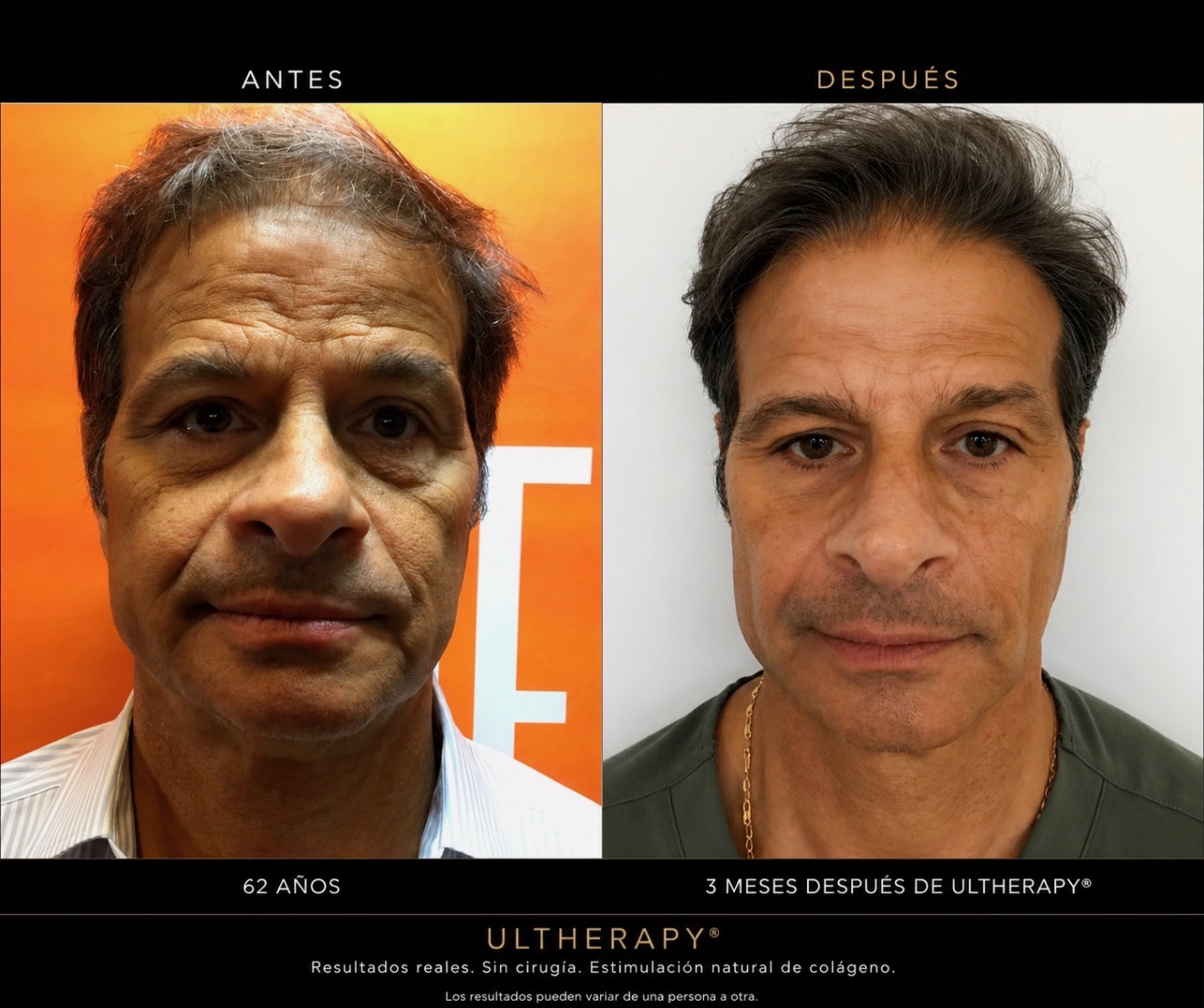Face — 3 months after Ultherapy