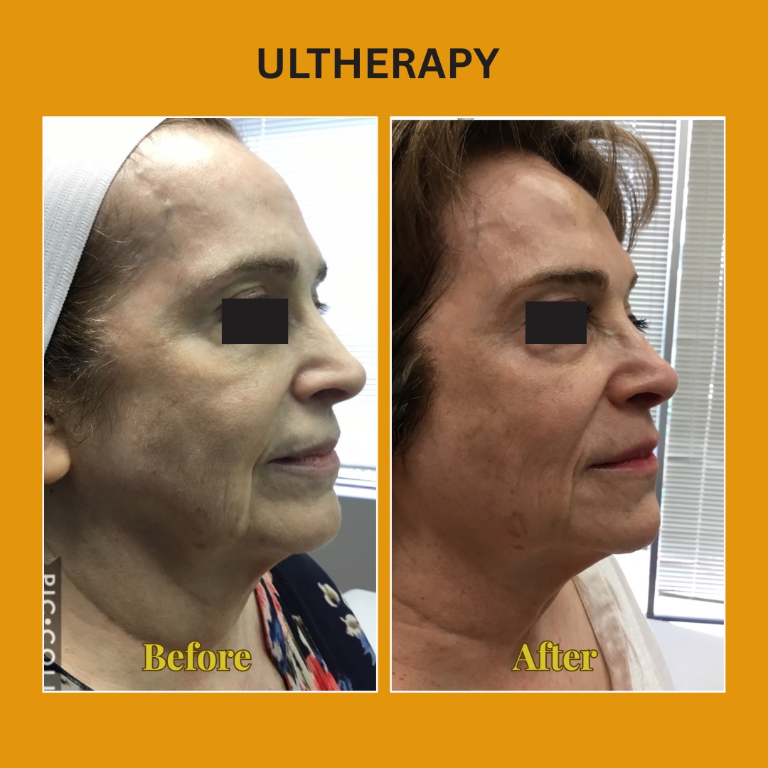 Face and jawline before and after Ultherapy