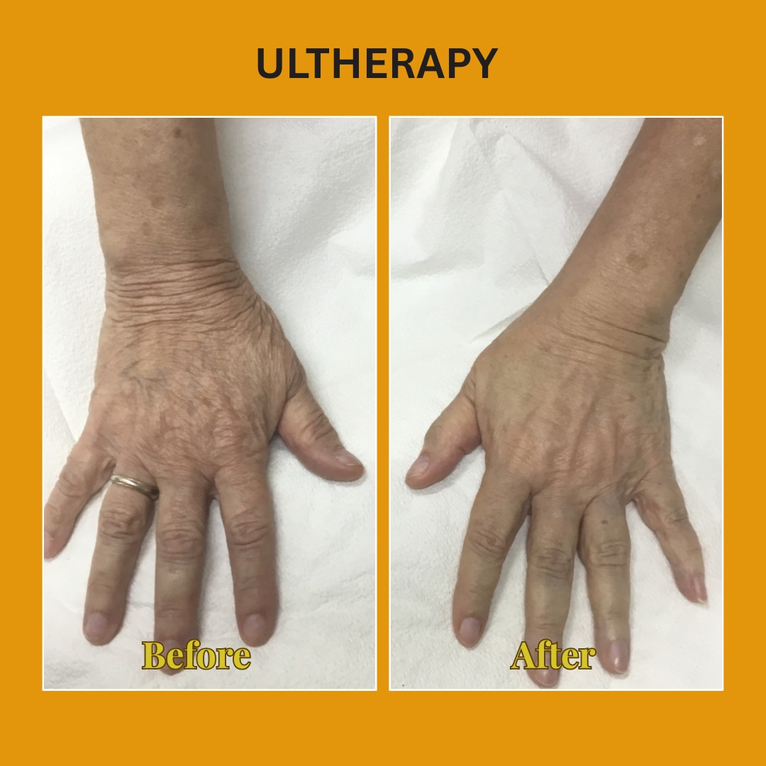 Hand before and after Ultherapy