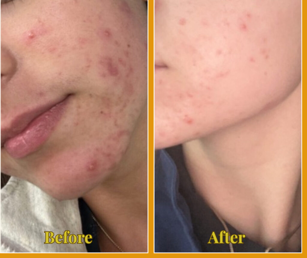 Ultherapy PRIME in Austin TX | Non-Surgical Face Lifting