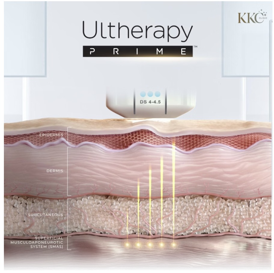 Ultherapy PRIME in Austin TX | Non-Surgical Face Lifting
