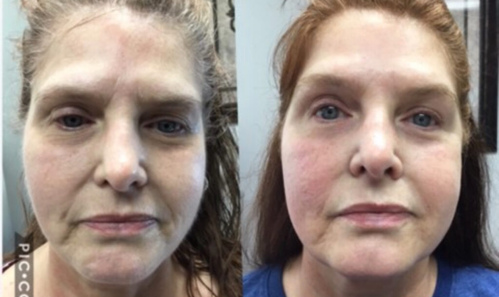Ultherapy PRIME in Austin TX | Non-Surgical Face Lifting